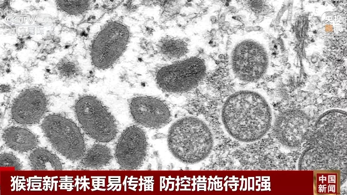猴痘变异新毒株可飞沫传播(猴痘病毒致死率有多高)